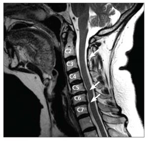 Pinched nerves in the neck may cause symptoms in the upper limb