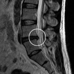 Sagittal MRI scan of the lumbar spine showing a suspected disc herniation, with the affected area circled in white for clarity.