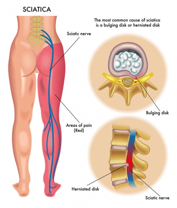 An anatomical diagram showing the sciatic nerve path from the lower spine down the leg, with close-up illustrations of bulging and herniated discs pressing on the nerve.