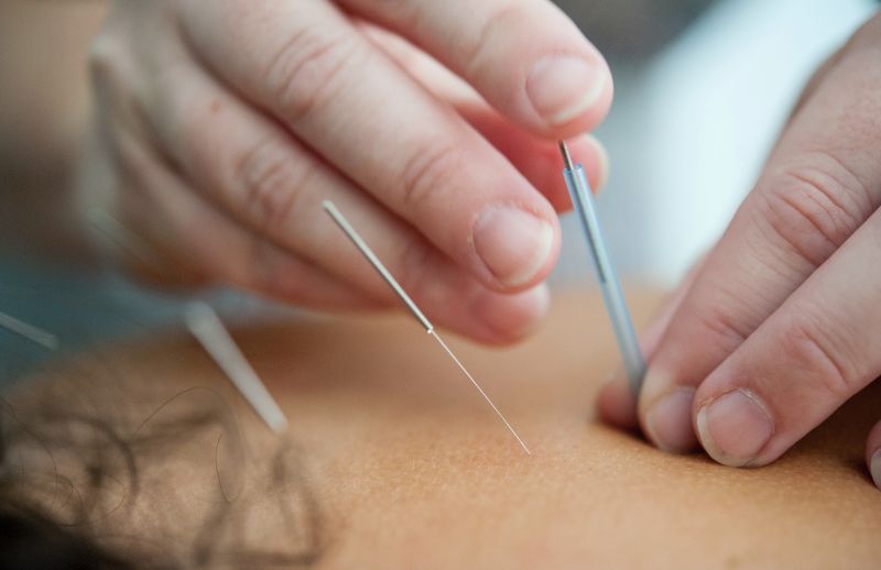 Chiropractic Vs Acupuncture