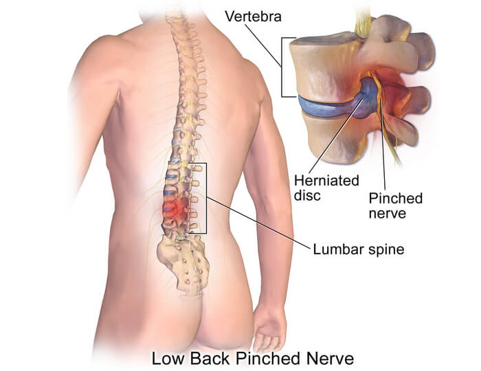 Pinched nerve from herniated disc